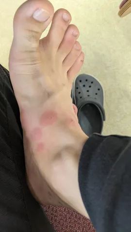 足の赤い斑点、虫刺され？